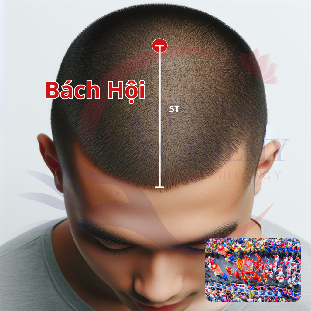 Huyệt Bách hội nằm chính giữa đỉnh đầu.