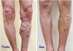 Bấm ngay 9 huyệt này giúp chữa suy giãn tĩnh mạch